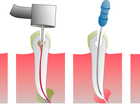 18 root canal treatment.png